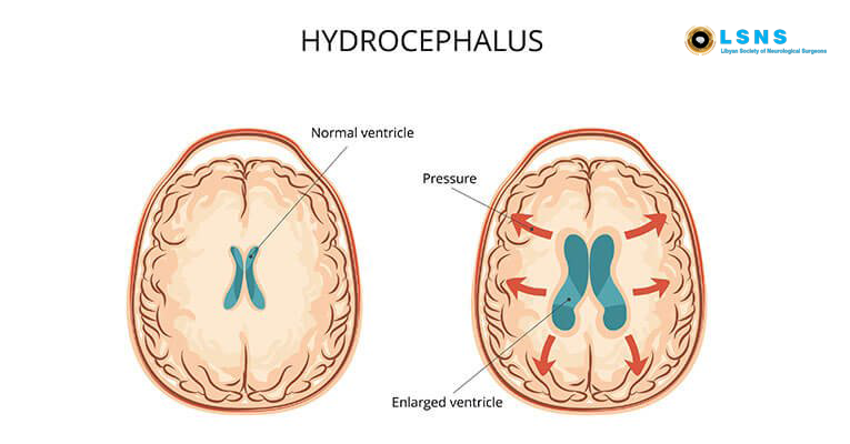 Hydrocephalus & Neural Tube Defects Workshop